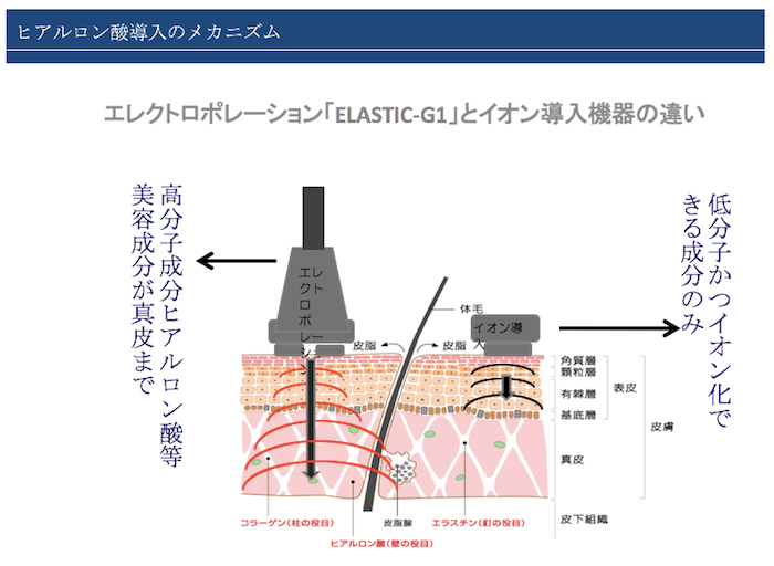 イオン導入方式の違い